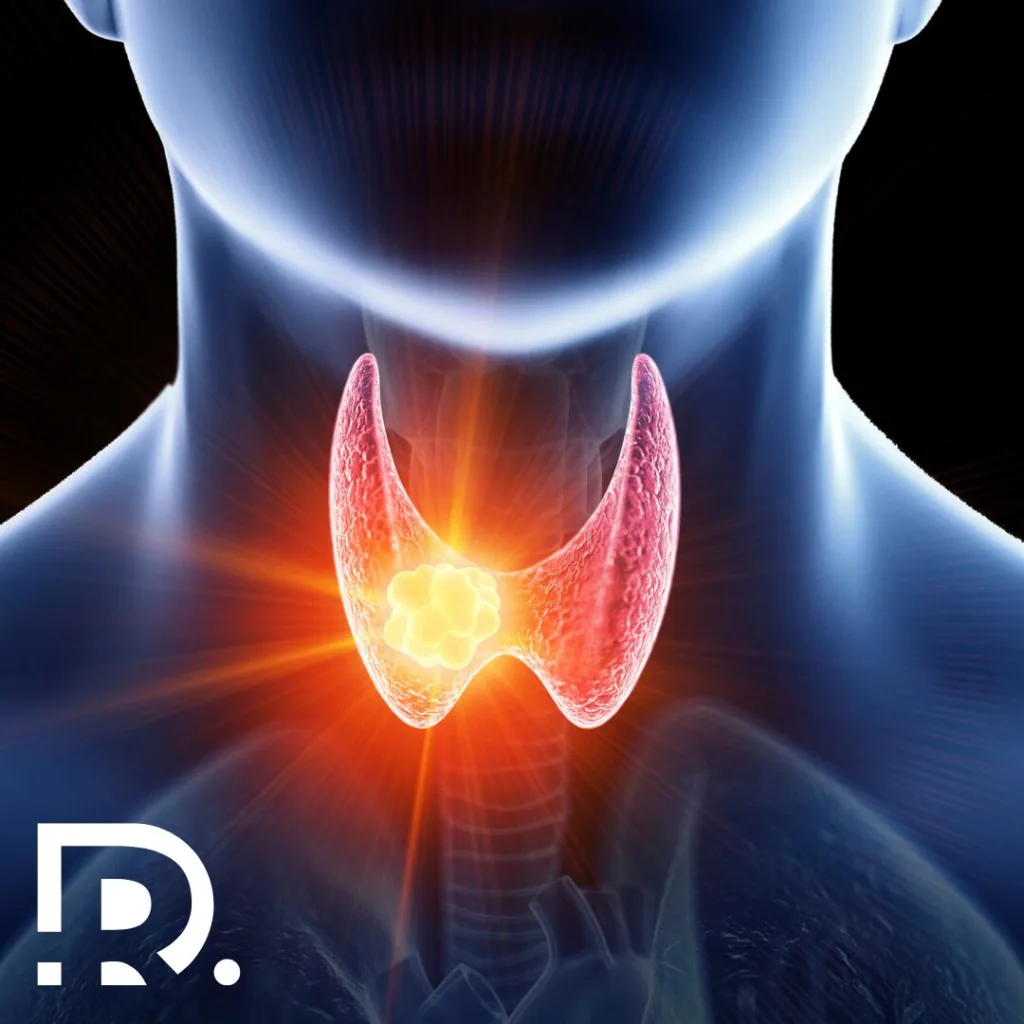 Tipurile de cancer tiroidian