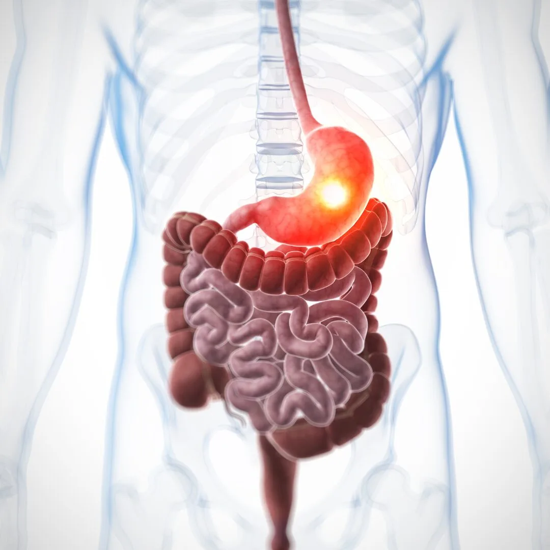 Tipurile cancerului gastric