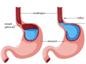 Boala de reflux gastroesofagian și hernia hiatală